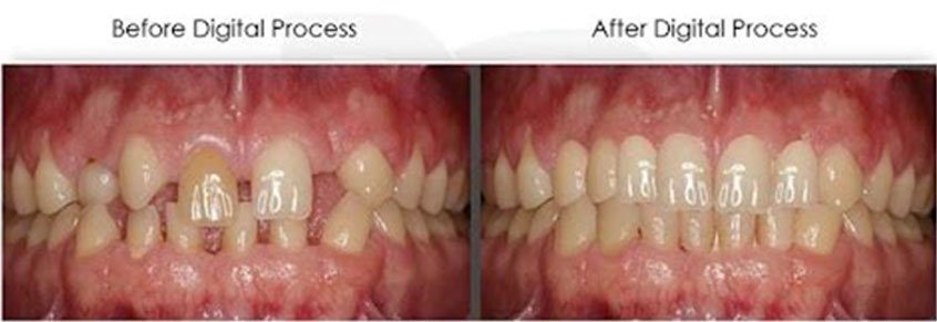 dental photo before and after treatment 1