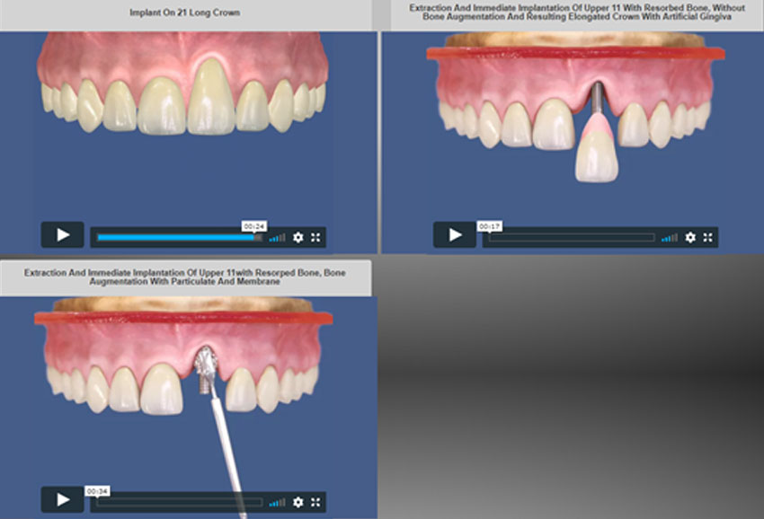 3 animations of dental implant